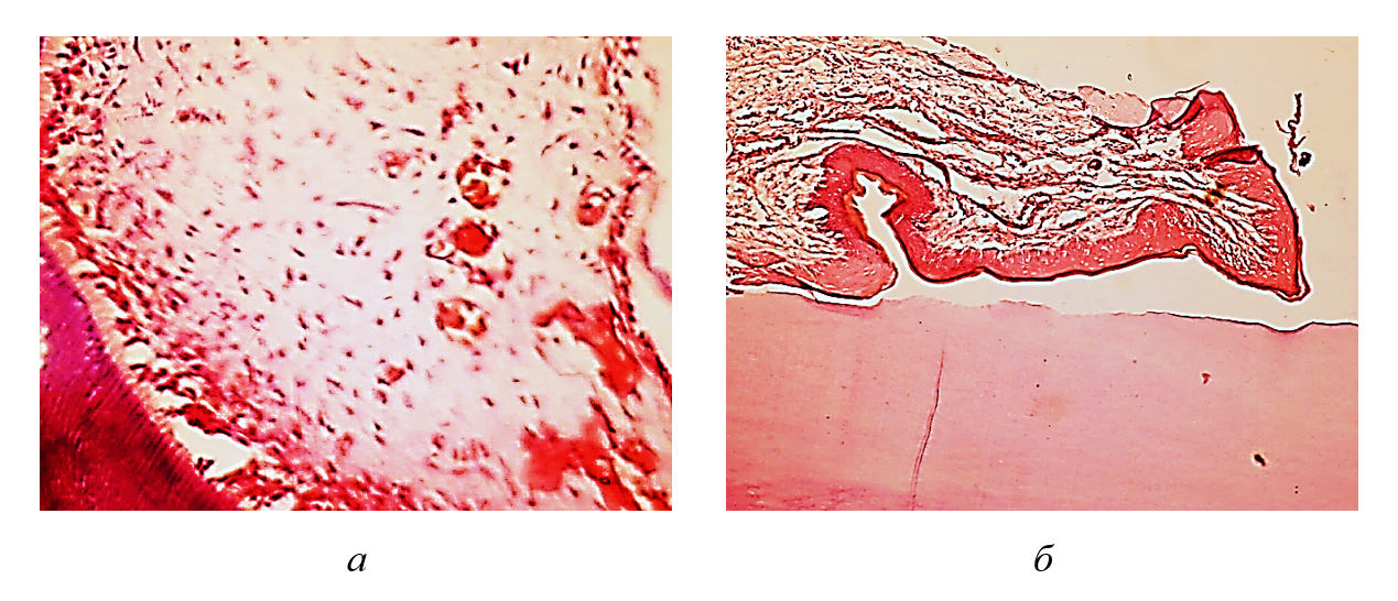 Умеренное воспаление в пульпе с разрастанием рыхлой волокнистой соединительной ткани и мелких сосудов: а – отек пульпы; б – зубодесневой карман с умеренным воспалением в мягких тканях; многослойный плоский ороговевающий эпителий