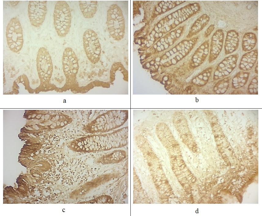 Экспрессия галектина-3 в различных участках стенки ободочной кишки при ИГХ:a) однородное умеренное иммуноокрашивание галектина-3 в кишечном эпителии крипт и выраженное иммуноокрашивание галектина-3 в поверхностном эпителии слизистой оболочки ободочной кишки пациента с долихоколон (контрольная); b) однородное распределение умеренно и, очагово, сильного позитивного иммуноокрашивания галектина-3 в слизистой оболочке ободочной кишки у пациента с дивертикулярной болезнью (стенка кишки без дивертикулов); c) выраженное иммуноокрашивание галектина-3 в поверхностном эпителии и эпителии крипт слизистой оболочки стенки ободочной кишки в зоне дивертикулов без осложнений; d) заметно пятнистое и неоднородное эпителиальное иммуноокрашивание, сильно позитивные клетки к галектину-3 чередуются с нереактивными клетками стенки ободочной кишки в зоне осложненных дивертикулов