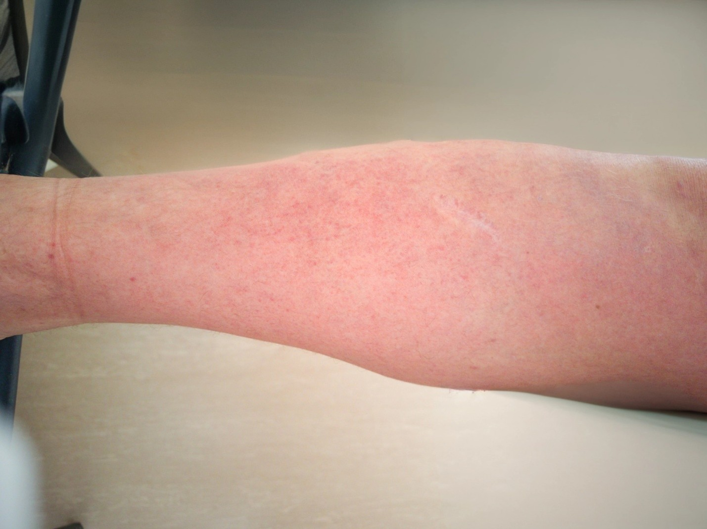 Мелкоточечная и петехиальная сыпь на нижних конечностях у пациента с лихорадкой чикунгунья