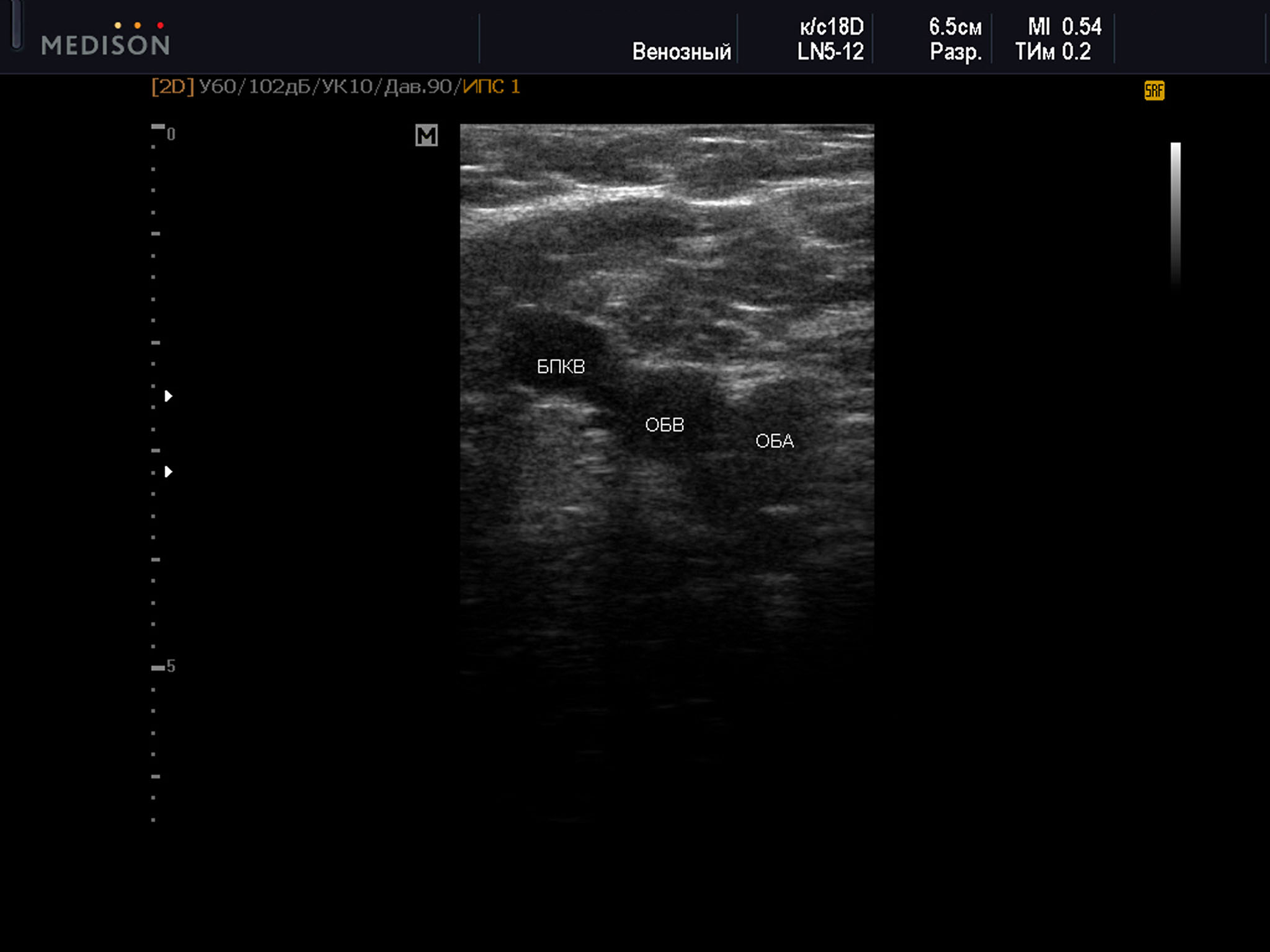  Пример диагностического ультразвукового изображения на уровне верхней трети бедра, поперечное сечение общей бедренной вены и общей бедренной артерии, Тип 2 взаимного положения сосудов