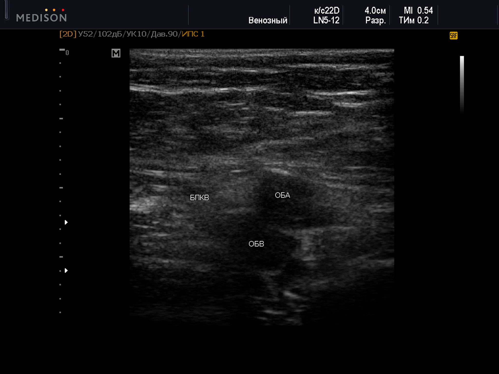 Пример диагностического ультразвукового изображения на уровне верхней трети бедра, поперечное сечение общей бедренной вены и общей бедренной артерии, Тип 6 взаимного положения сосудов