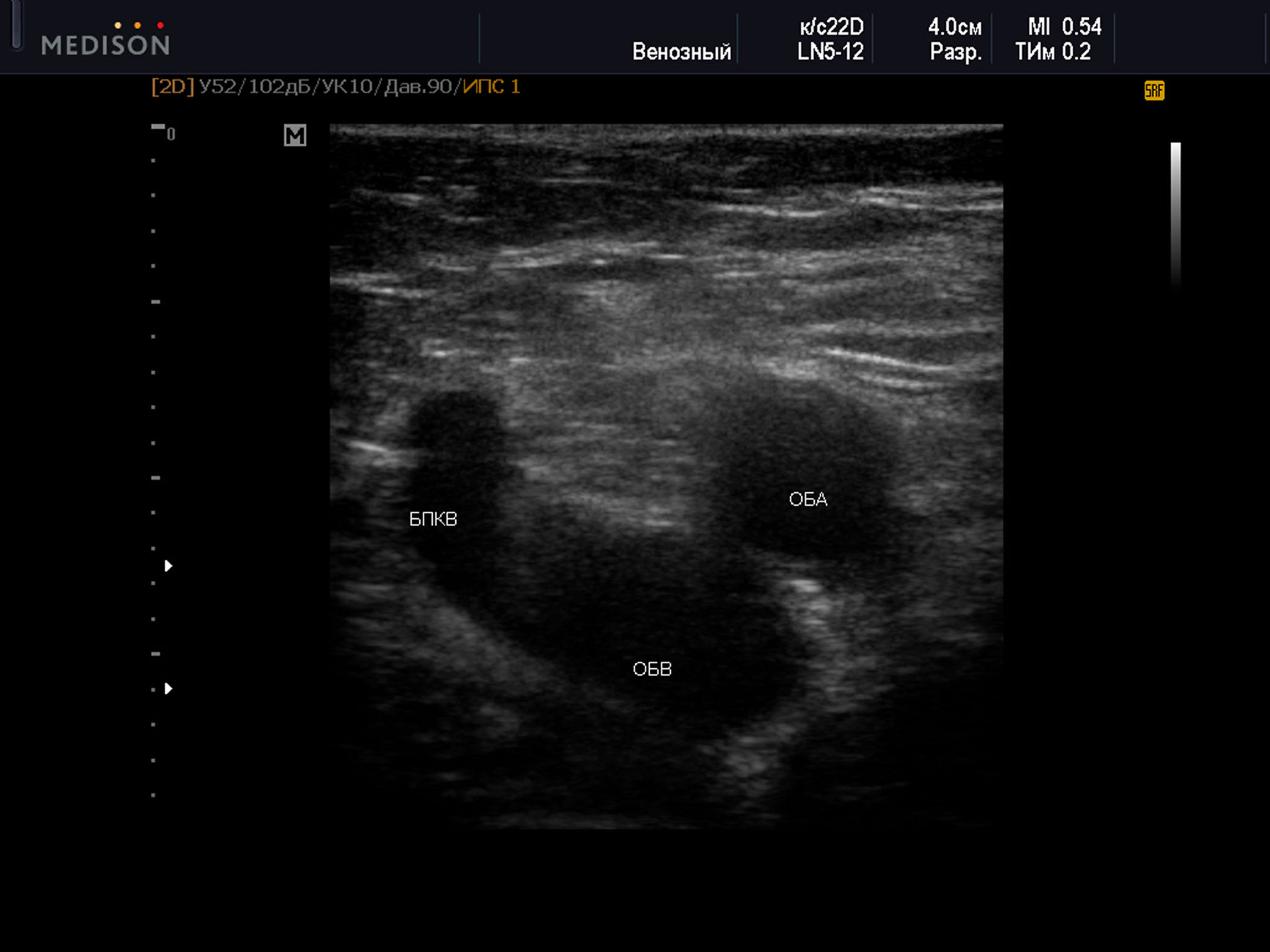 Пример диагностического ультразвукового изображения на уровне верхней трети бедра, поперечное сечение общей бедренной вены и общей бедренной артерии, Тип 3 взаимного положения сосудов