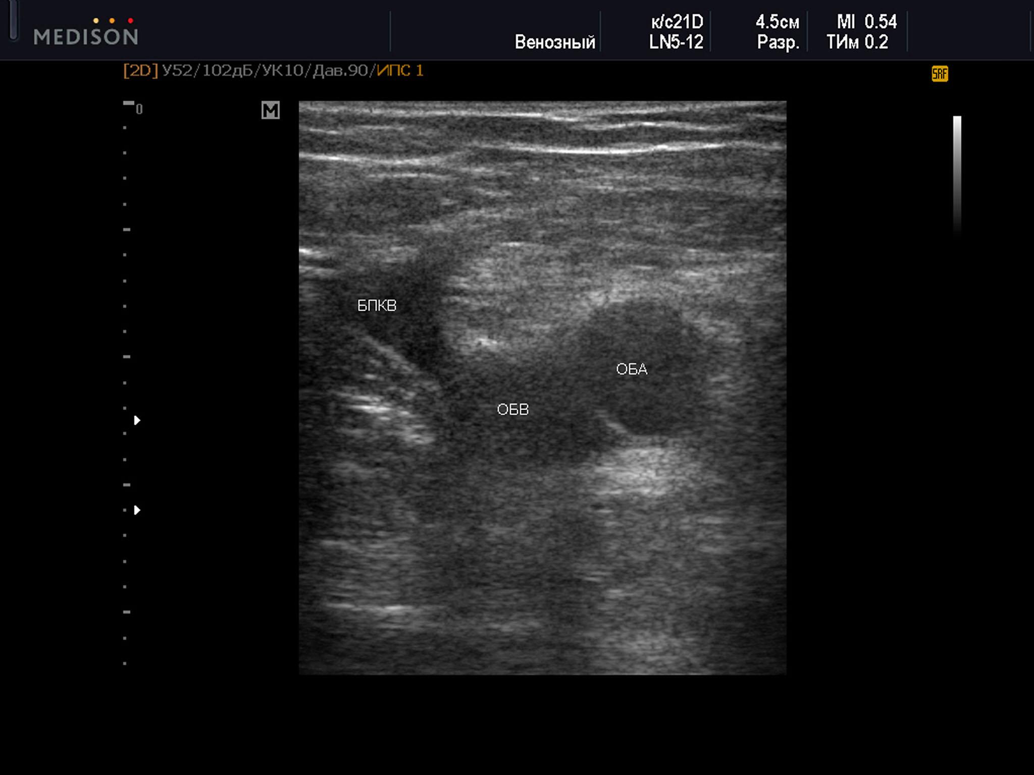  Пример диагностического ультразвукового изображения на уровне верхней трети бедра, поперечное сечение общей бедренной вены и общей бедренной артерии, Тип 4 взаимного положения сосудов