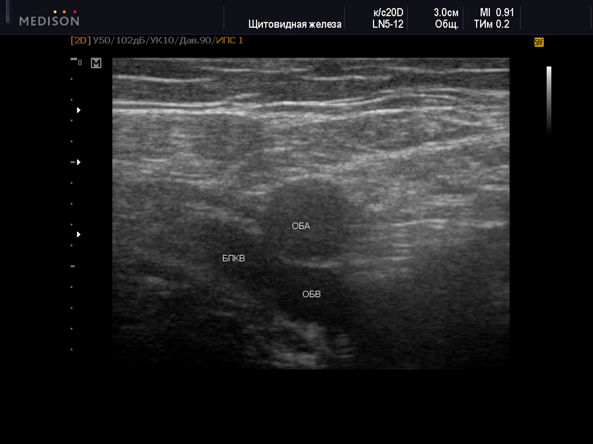 Пример диагностического ультразвукового изображения на уровне верхней трети бедра, поперечное сечение общей бедренной вены и общей бедренной артерии, Тип 1 взаимного положения сосудов