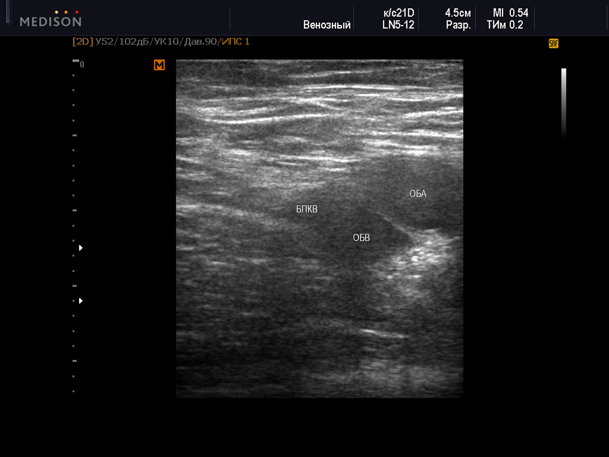 Пример диагностического ультразвукового изображения на уровне верхней трети бедра, поперечное сечение общей бедренной вены и общей бедренной артерии, Тип 5 взаимного положения сосудов